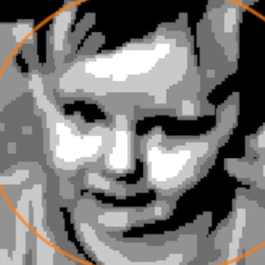 Vision Restored Using Prosthetic Retinal Implant