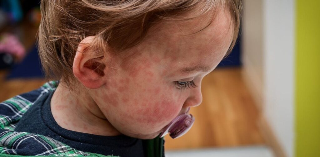 Canada loses its official ‘measles-free’ status – and the US will follow soon, as vaccination rates fall