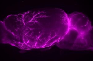 Brain’s ‘plumbing’ inspires new Alzheimer’s strategies—and controversial surgeries